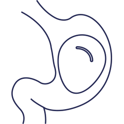 بالون المعدة